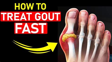 home treatment for gout in big toe.